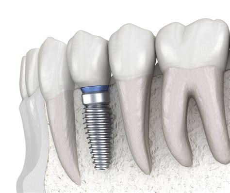 Parodontologe für Zahnimplantate
